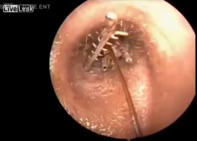 You Won't Believe What Doctors Found Lurking in This Man's Ear