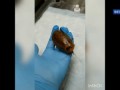В России врачи сделали уникальную операцию таракану