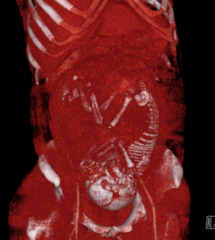 429px-Volume_rendered_CT_scan_of_a_pregnancy_of_37_weeks_of_gestational_age_smaller-1545041673