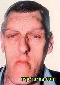 1316404772_acromegaly