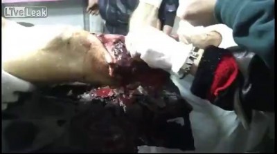 Травма ноги.сирия 