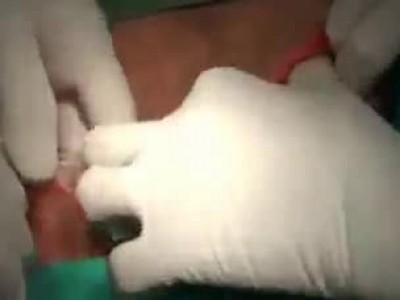 Кесарево сечение